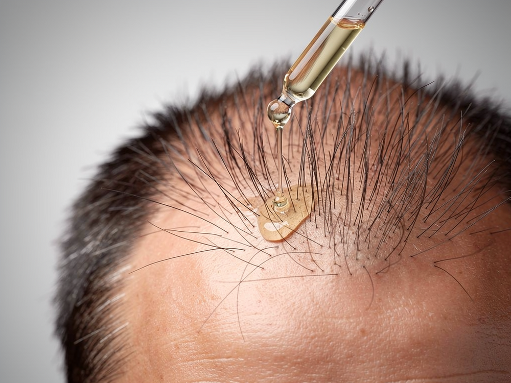 Saw Palmetto as Finasteride Alternative: Does It Block DHT Without Sexual Side Effects?