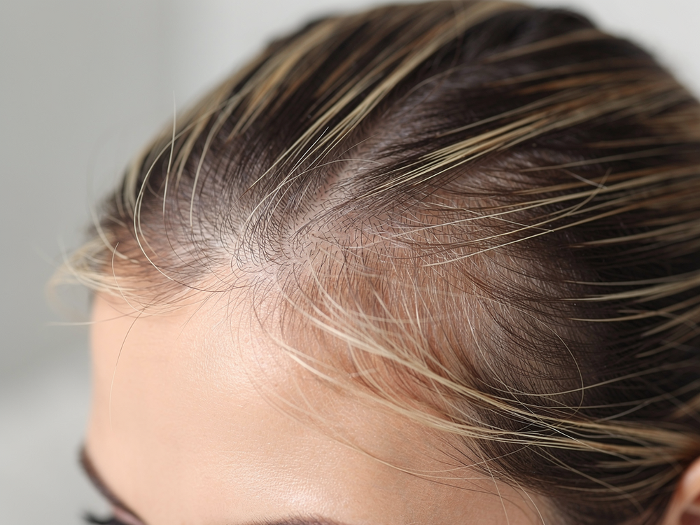 Why Saw Palmetto DHT Blocker Isn’t Stopping Hair Loss in Women Over 40